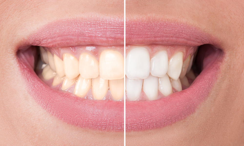 Same Day Teeth Whitening - Alameda Dental Care in Tempe, AZ