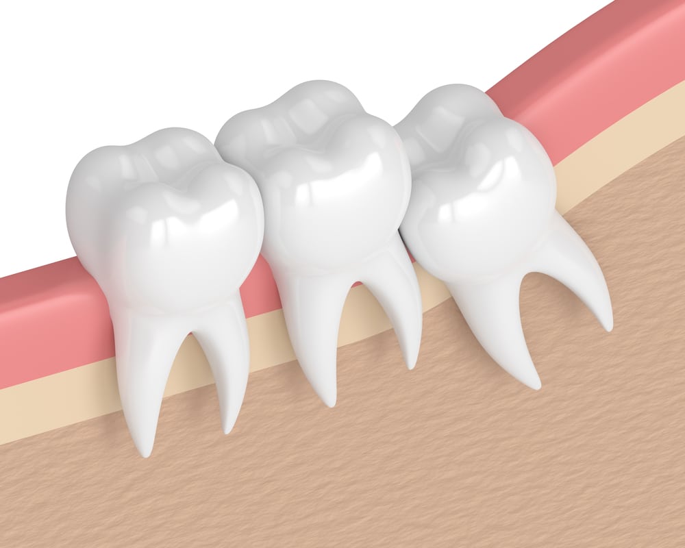 Wisdom Teeth Removal - Alameda Dental Care in Tempe, AZ