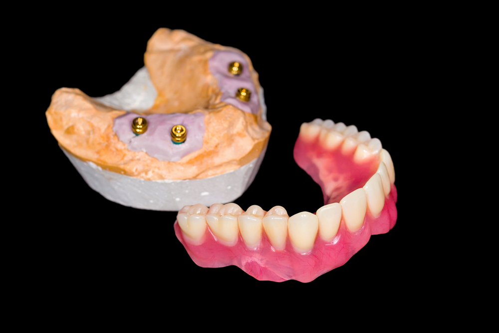 Implant Supported Dentures - Alameda Dental Care Team in Tempe, AZ