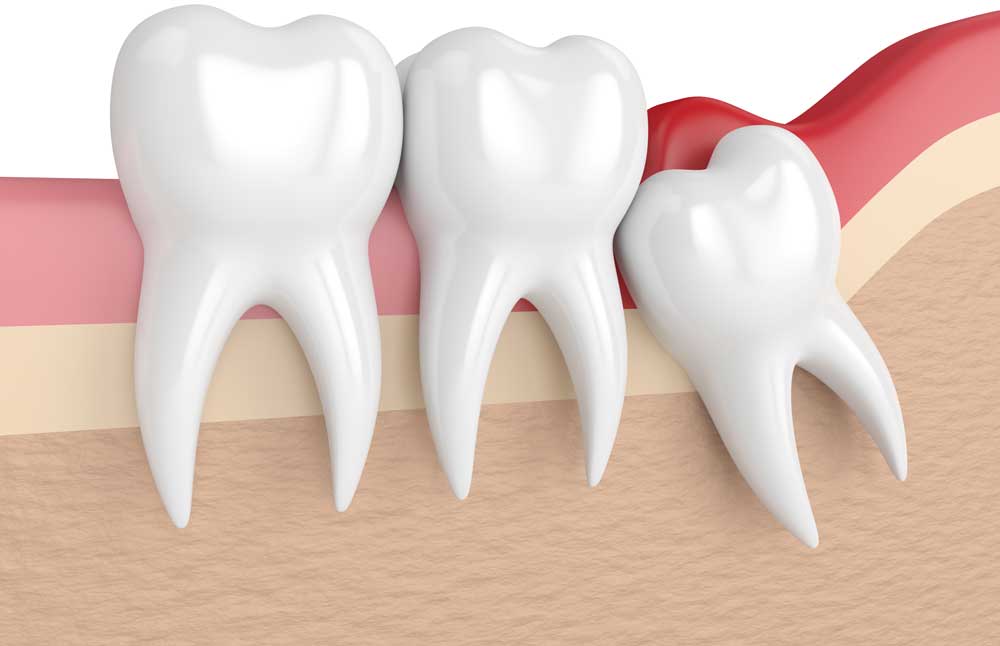 Wisdom Teeth Removal in Tempe - Alameda Dental Care
